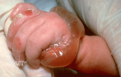 Junctional epidermolysis bullosa blisters on a newborn's hands