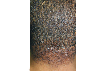 Early acne keloidalis nuchae on back of scalp