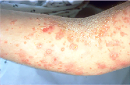 staph infection on child's arm