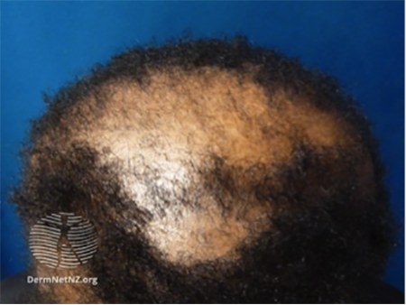 Alopecia  Stock Image  M1080620  Science Photo Library