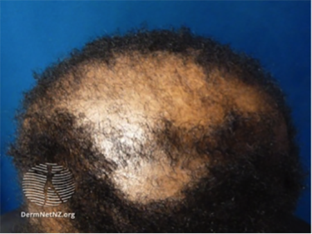 balding area on top of head