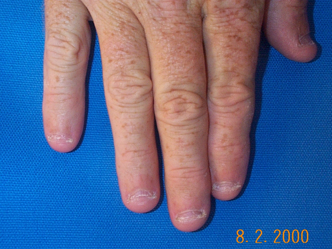 Details more than 67 nail biting icd 10 best