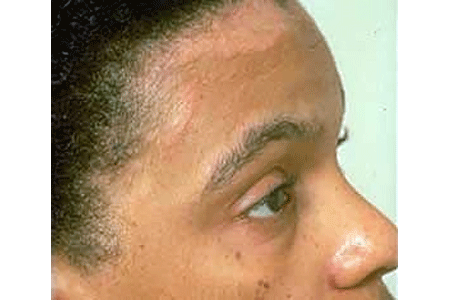Seborrheic dermatitis on a woman’s forehead, eyelids, and nose