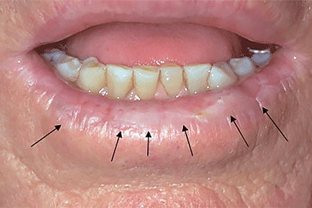 skin precancerous growth keratosis actinic lip horn rough patch spot cancer look