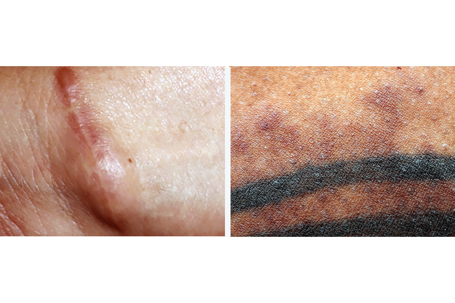 Sarcoidal granulomas in a cosmetic tattoo in association with pulmonary  sarcoidosis  Baumgartner  2010  JDDG Journal der Deutschen  Dermatologischen Gesellschaft  Wiley Online Library