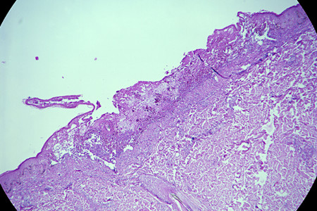 Varicella-zoster