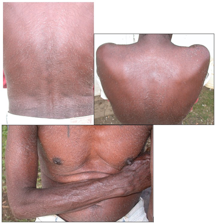Kava dermopathy on lumbar region of an intermittently employed man who consumes large amounts of kava every evening in a deritualized manner. His acquired ichthyosis will resolve with abstinence from drinking kava