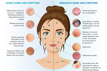 Distinguish acne from rosacea