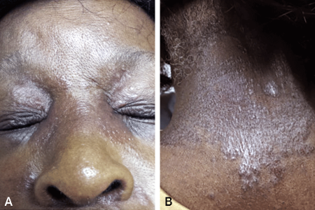 Bumps, patches, and discolored skin on face and back of neck due to sarcoidosis