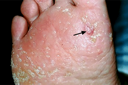 A round growth with raised borders on the bottom of this patient's foot is squamous cell carcinoma