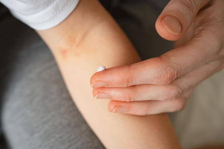 Patient with atopic dermatitis applying a gentle moisturizer to arm