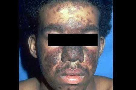 A common sign of accute cutaneous lupus is butterfly rash