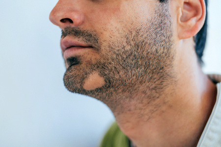 Man with patch of alopecia areata on his beard