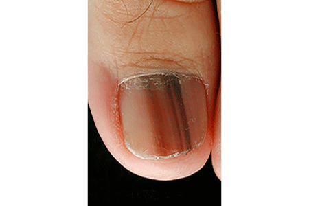 Melanoma beneath a toenail