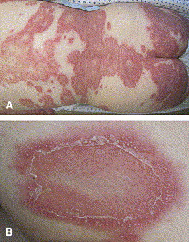 A DWII image of a patient with psoriasis flares 