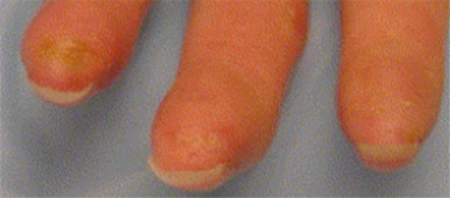 Sores and pitted scars on fingertips of person with scleroderma