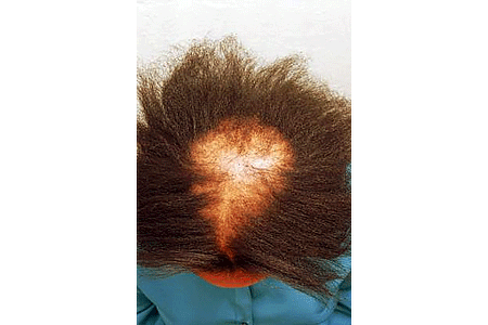 Large area of hair loss due to CCCA