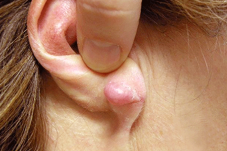 Keloid scar on underside of earlobe