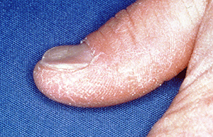 Spoon-shaped nails