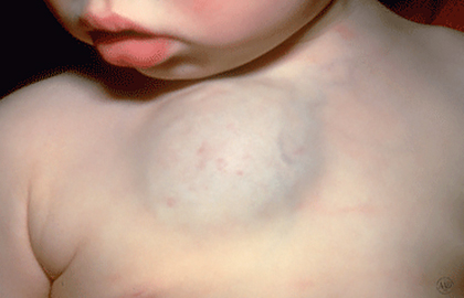 Deep hemangioma on baby's chest