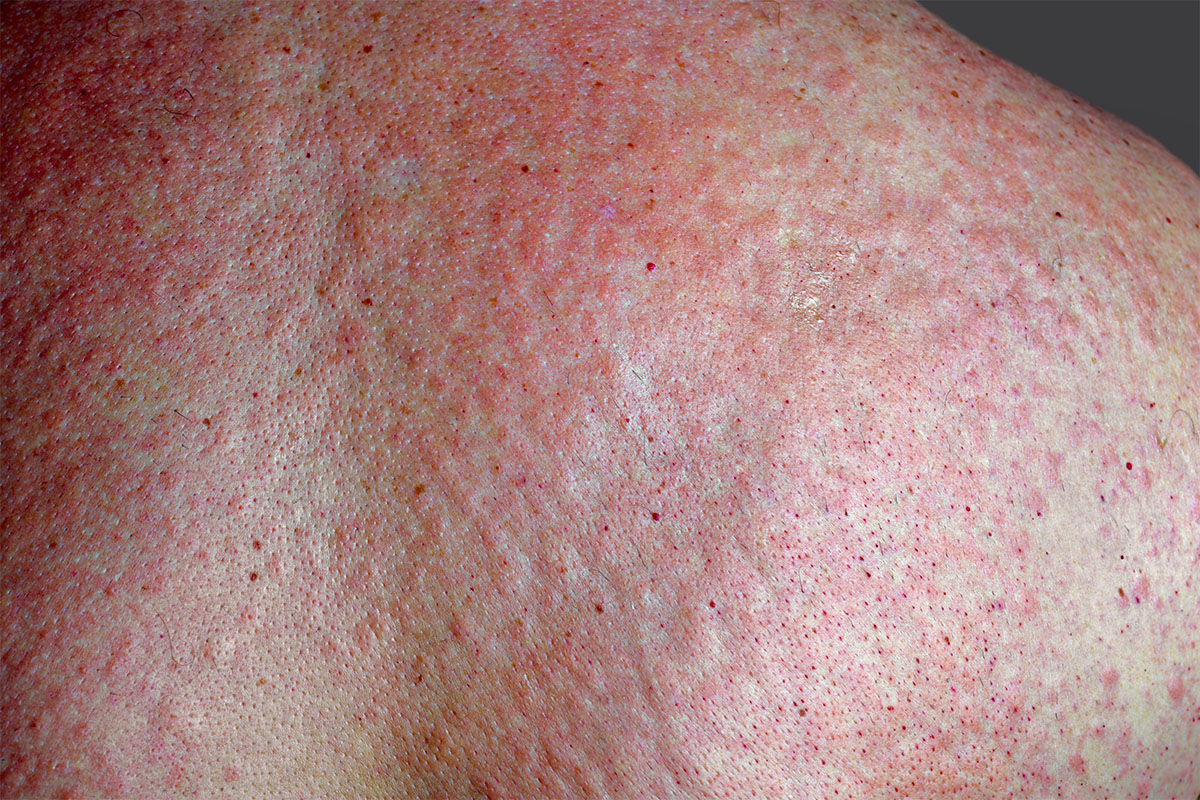 clinical image of covid-19 rash