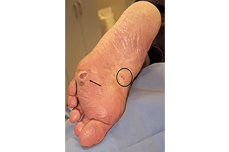 Melanoma on the bottom of a foot can look like an open sore