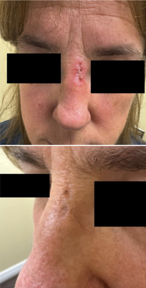 Before and after images for tapinarof on the face of a white male | American Academy of Dermatology (AAD).