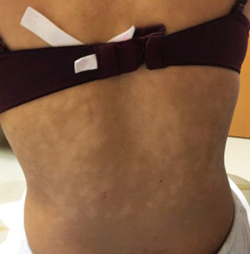 Image of progressive macular hypomelanosis (PMH) for DWII