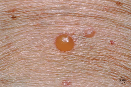 Large blister of bullous pemphigoid