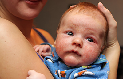 A skin infection can look a lot like eczema. Baby with eczema