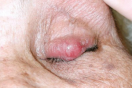 A rapidly growing stye on this patient's eyelid is an aggressive skin cancer called Merkel cell carcinoma