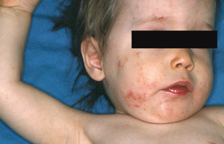 Rash on baby's face