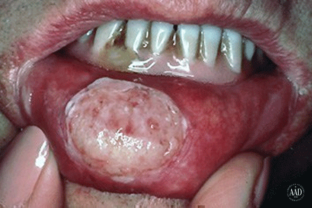 Large sore inside the mouth and on the lower lip is squamous cell skin cancer