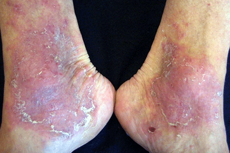 Stasis dermatitis inner ankles