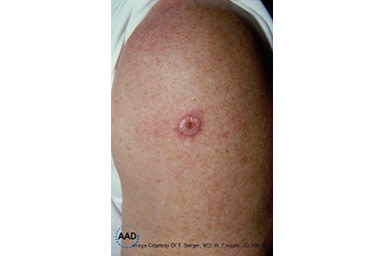 A reddish pink, dome-shaped growth with raised borders on this patient’s upper arm is squamous cell carcinoma | American Academy of Dermatology (AAD).