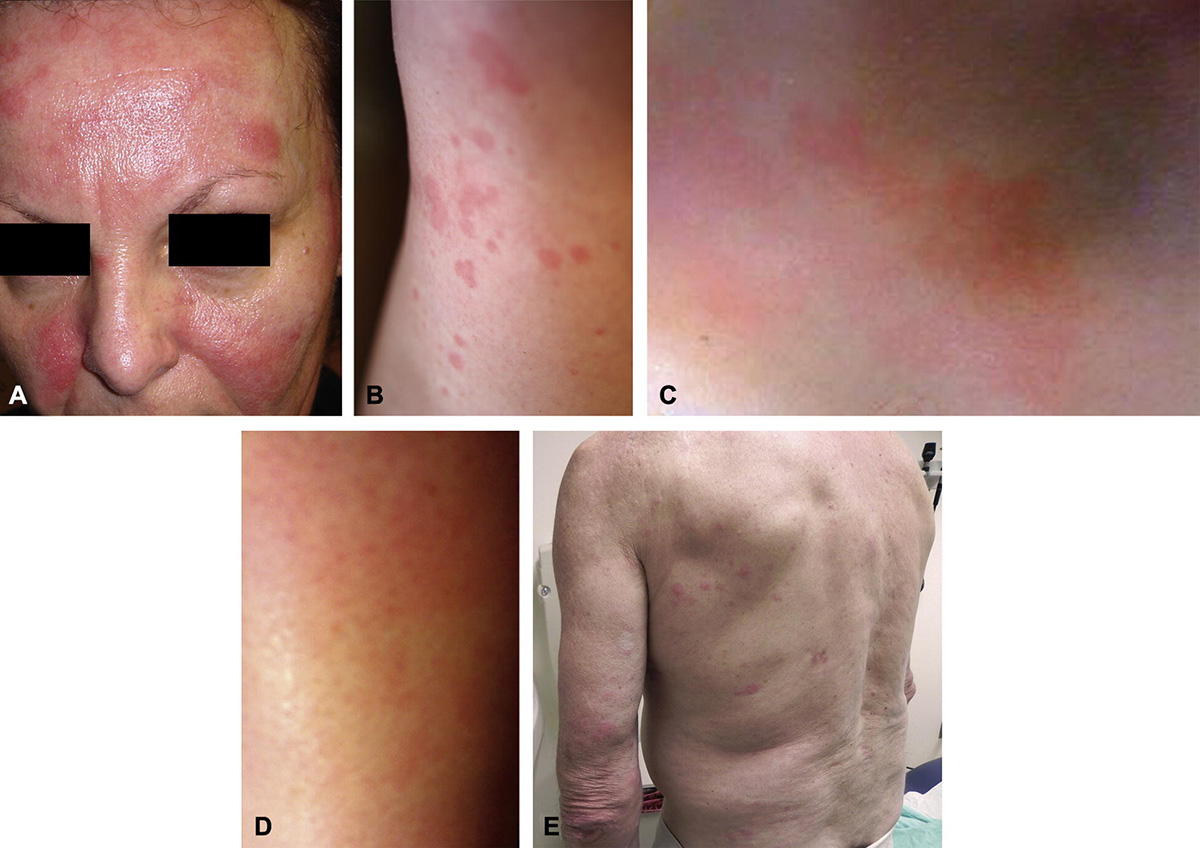 Image for DWII of NOD2 mutations and Yao Syndrome