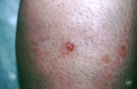A red spot on this patient's shin tested positive for Merkel cell carcinoma