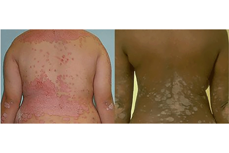 Psoriasis on the back and arms of a patient with a lighter skin tone and a patient with a darker skin tone