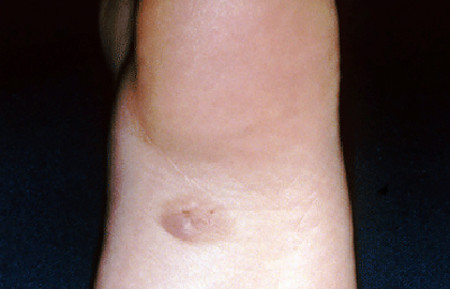 Mole on child's skin