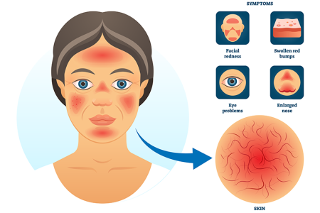 Overview illustration of Rosacea