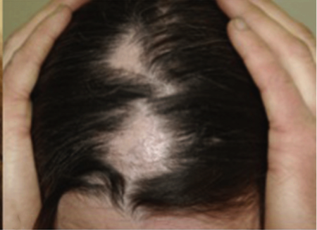 Hair Loss Types Alopecia Areata Signs And Symptoms