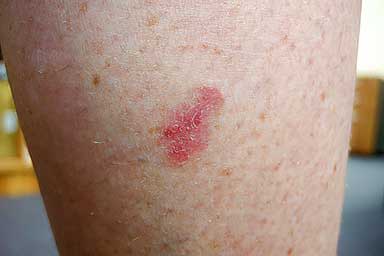 Pinkish scaly patch on patient’s leg is basal cell carcinoma | American Academy of Dermatology