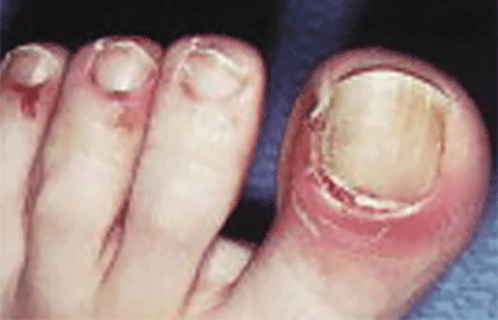 Pemphigus can affect the nails and surrounding skin
