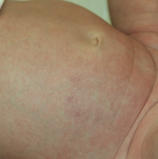 Image for DWII on transient abdominal telangiectasia of the newborn (TATN)