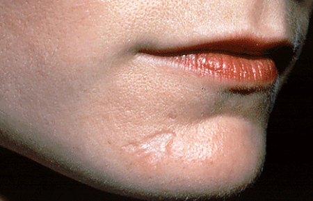 Scar on woman's chin