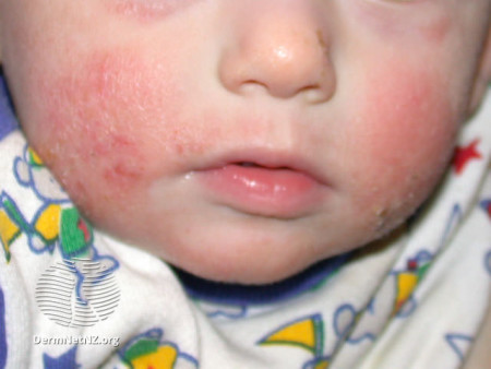 atopic dermatitis on infant's face