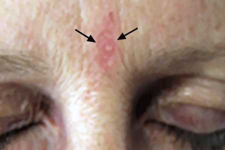 Close-up of basal cell carcinoma on forehead of patient