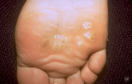 Plantar warts on the sole of a foot