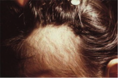 فردی که موهای نازک ناشی از تریکوتیلومانیا را نشان می دهد