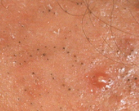 Blackheads and pimples